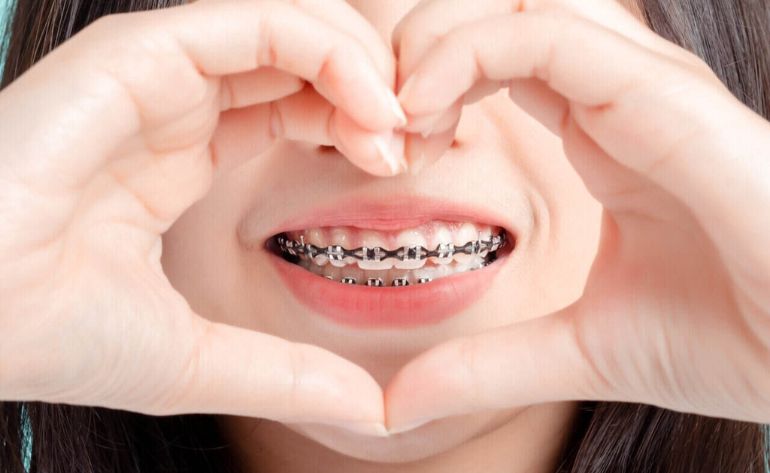 Braces Treatment in Sinhagad Road Pune