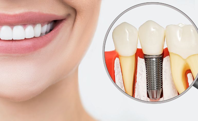 Dental Implant Treatment in sinhagad road Pune