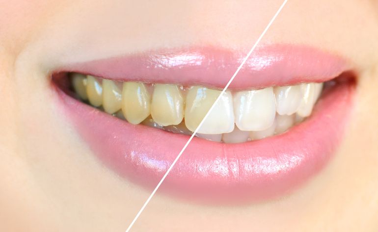 Teeth Whitening in Sinhagad Road Pune