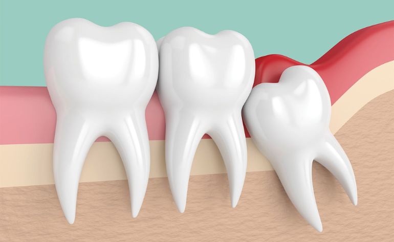 Wisdom Tooth Removal Sinhagad road Pune