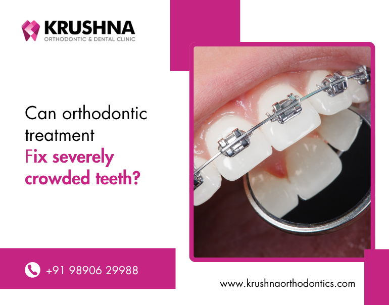 Can orthodontic treatment fix severely crowded teeth?