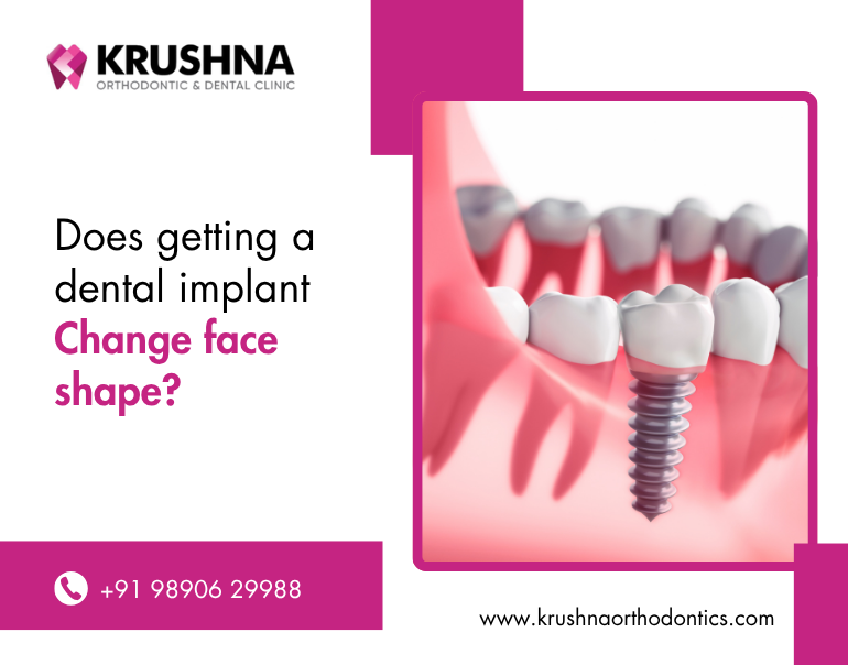 Does getting a dental implant change face shape?